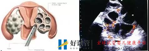 AMH能预测试管婴儿成功吗?(图1) AMH能预测试管婴儿成功吗?(图1)