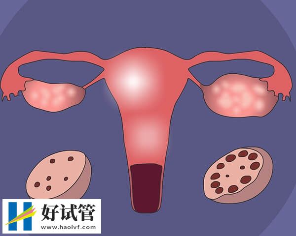 多囊卵巢的治疗方法有哪些(图1)