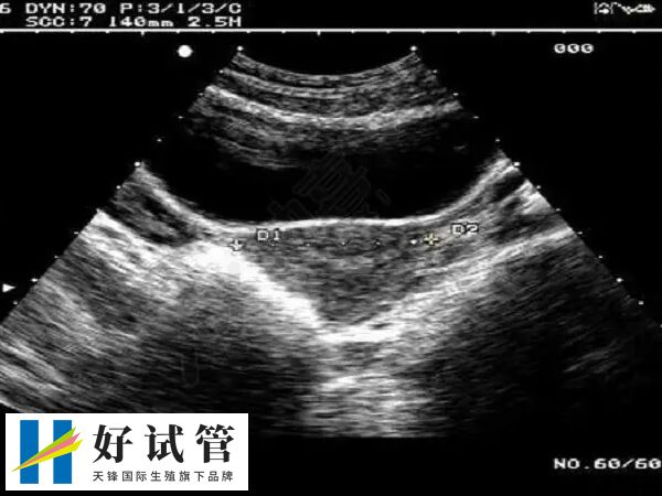 子宫内膜异位症可能会影响排卵