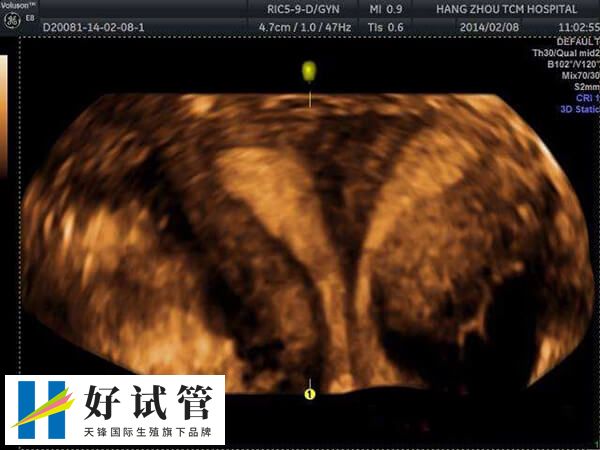 单胚胎移植可显著降低多胎妊娠风险