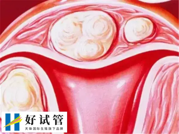 子宫具有天然的铲除异物的才能